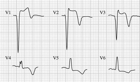 lv aneurysm ecg